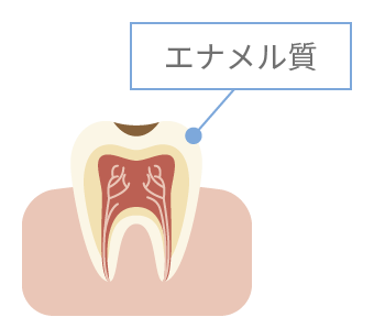エナメル質のむし歯 イメージ
