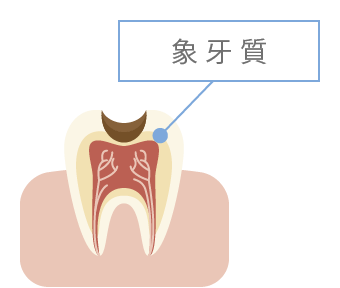 象牙質のむし歯 イメージ