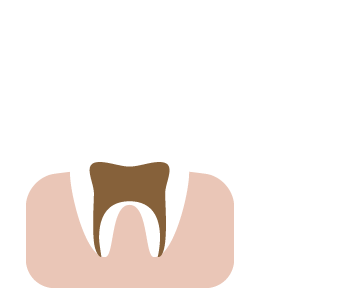 歯根に進行したむし歯 イメージ